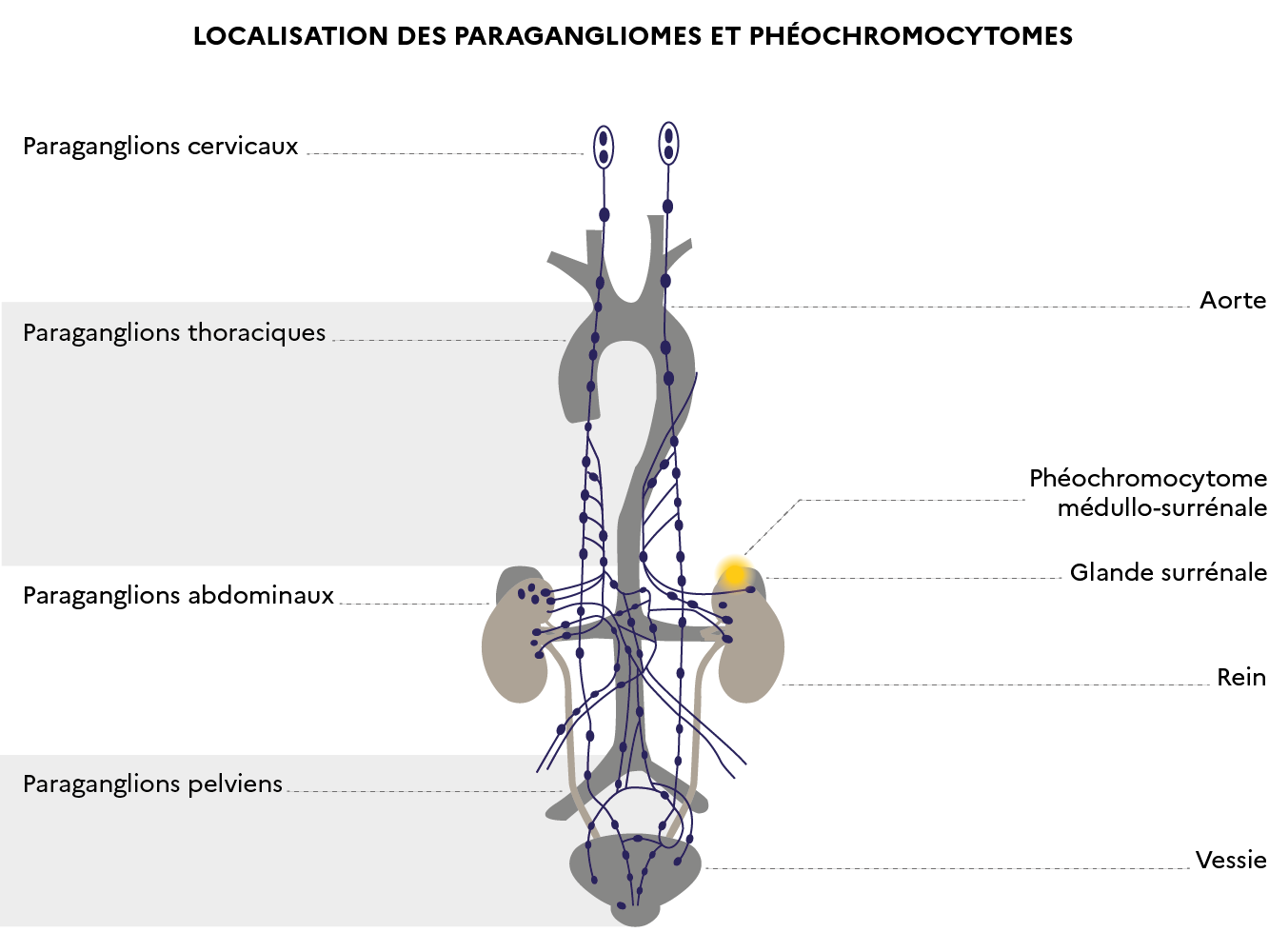 Localisation des pheochromocytomes et paragangliomes malins.png