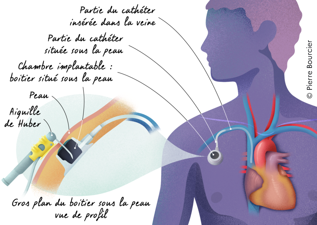 La chambre à cathéter implantable