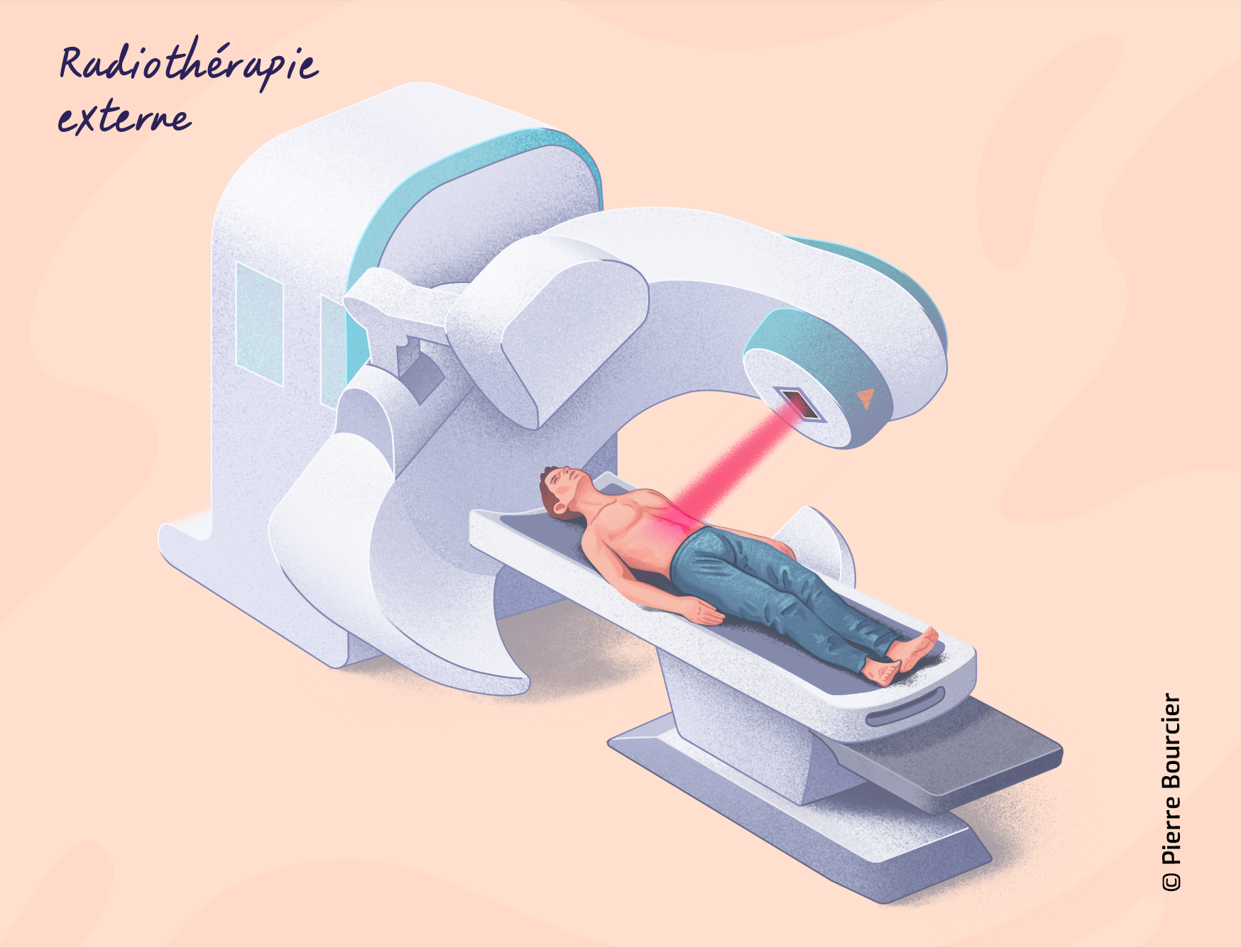 Illustration de la radiothérapie externe