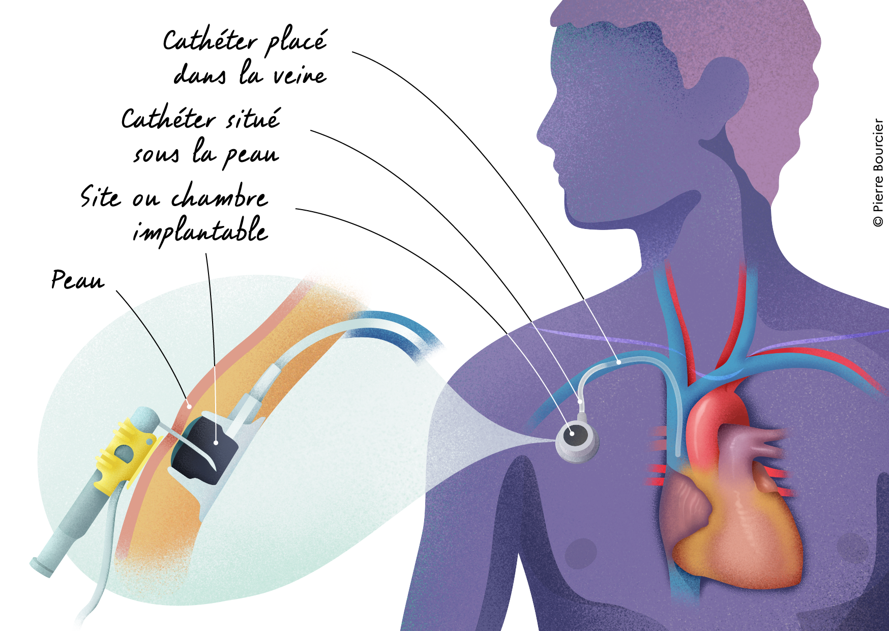 La chambre implantable