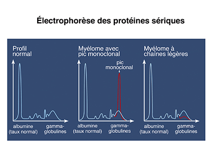 Electrophorèse des protéines sériques