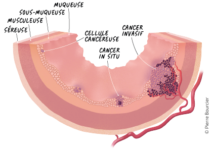 Illustration du développement d'un cancer par Pierre Bourcier