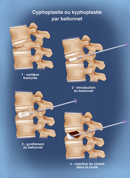 Illustration de cyphoplastie ou kyphoplastie par ballonnet