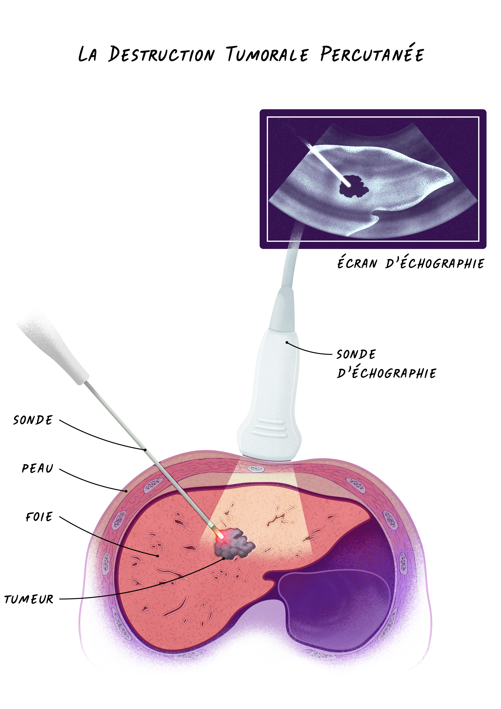 17b Cancers Foie - La Destruction Tumorale Percutanée.png