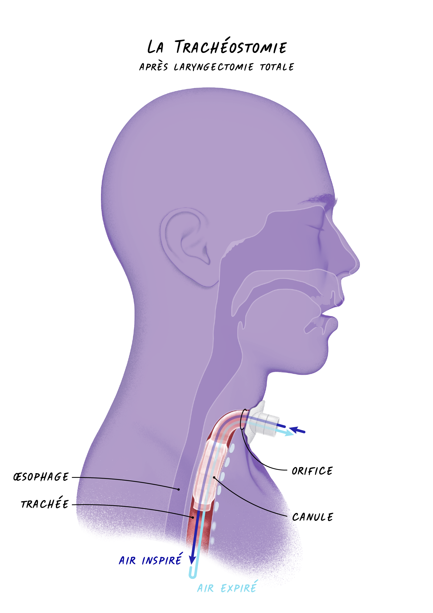 23a Cancers Sphère ORL - La Trachéostomie.png