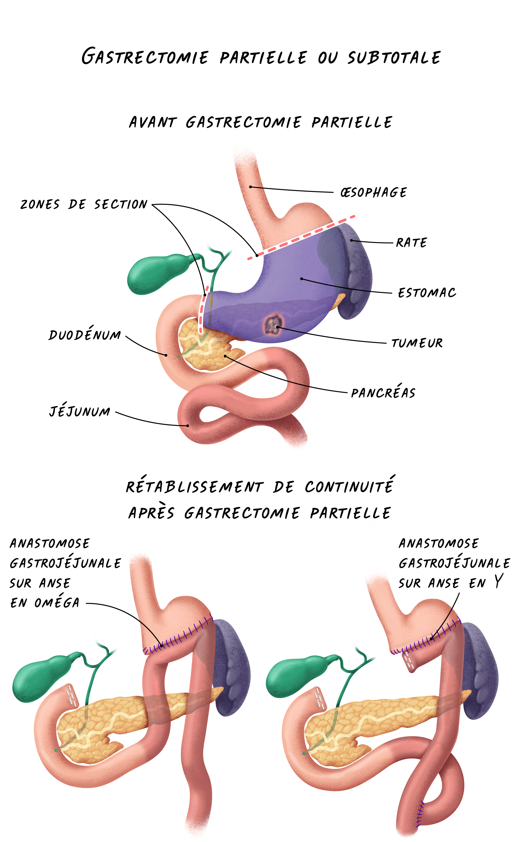 Schéma présentant la technique de la gastrectomie partielle ou subtotale