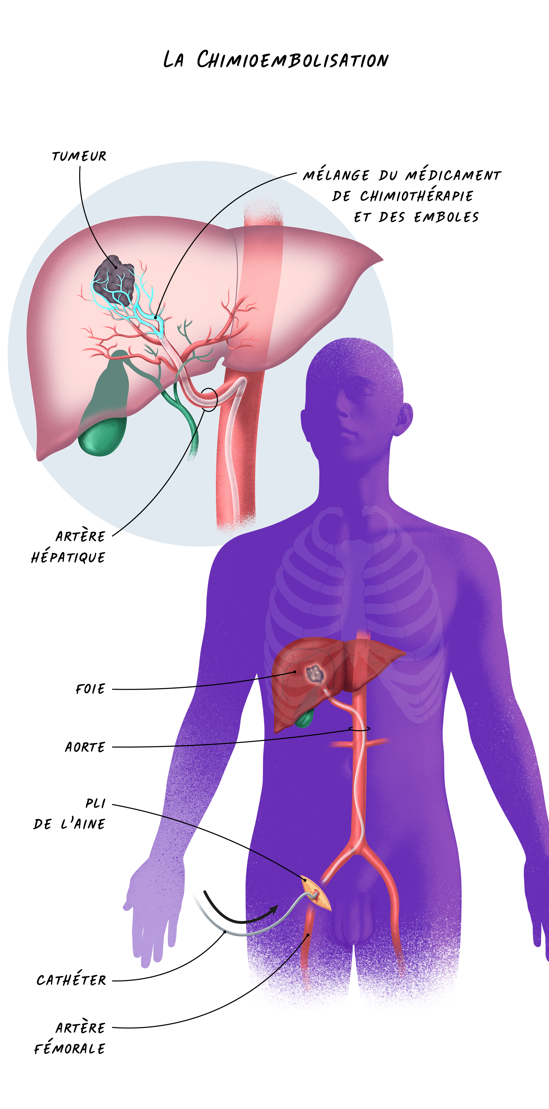 17d Cancers Foie - La Chimioembolisation.png