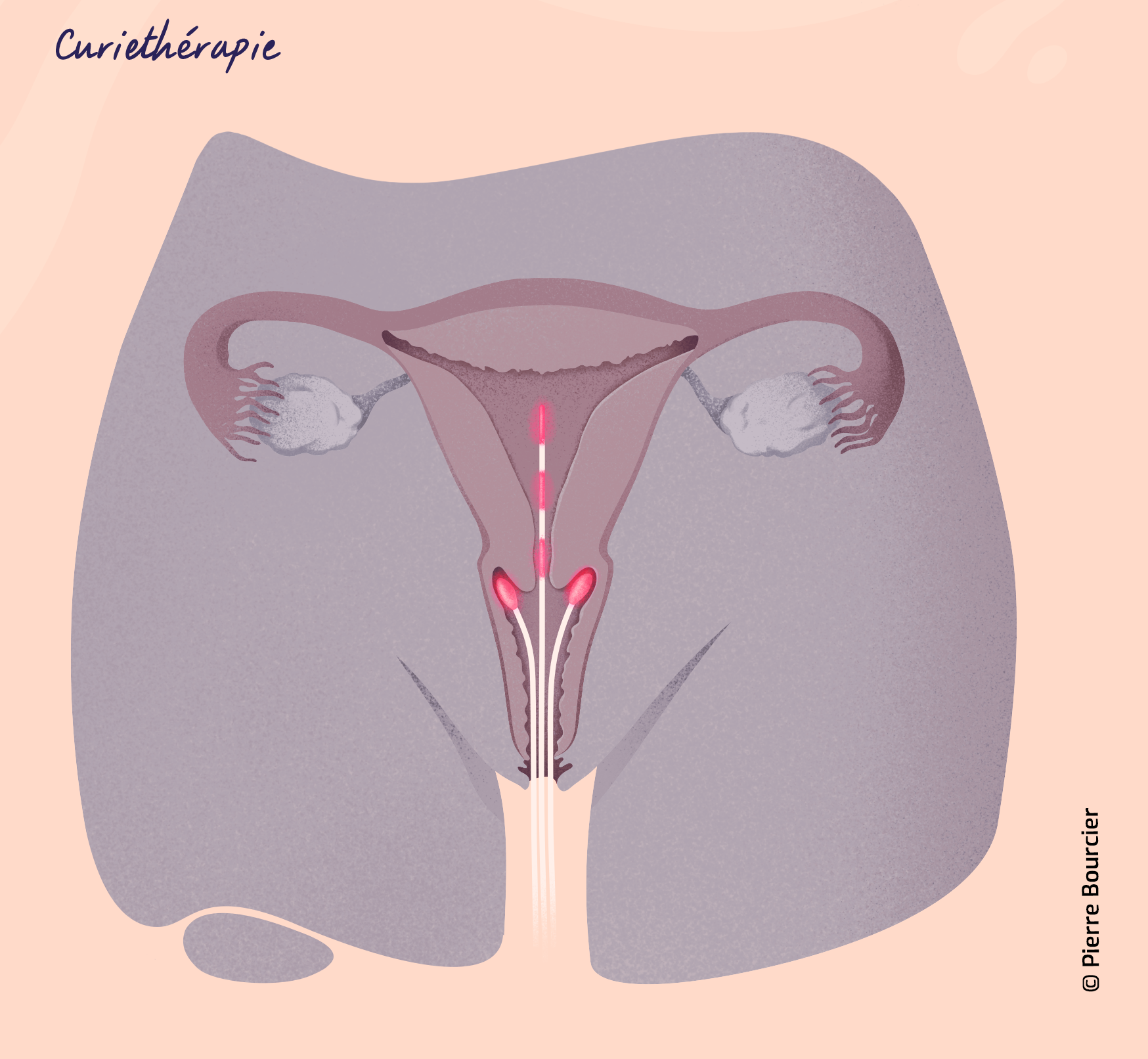 Illustration de la curiethérapie