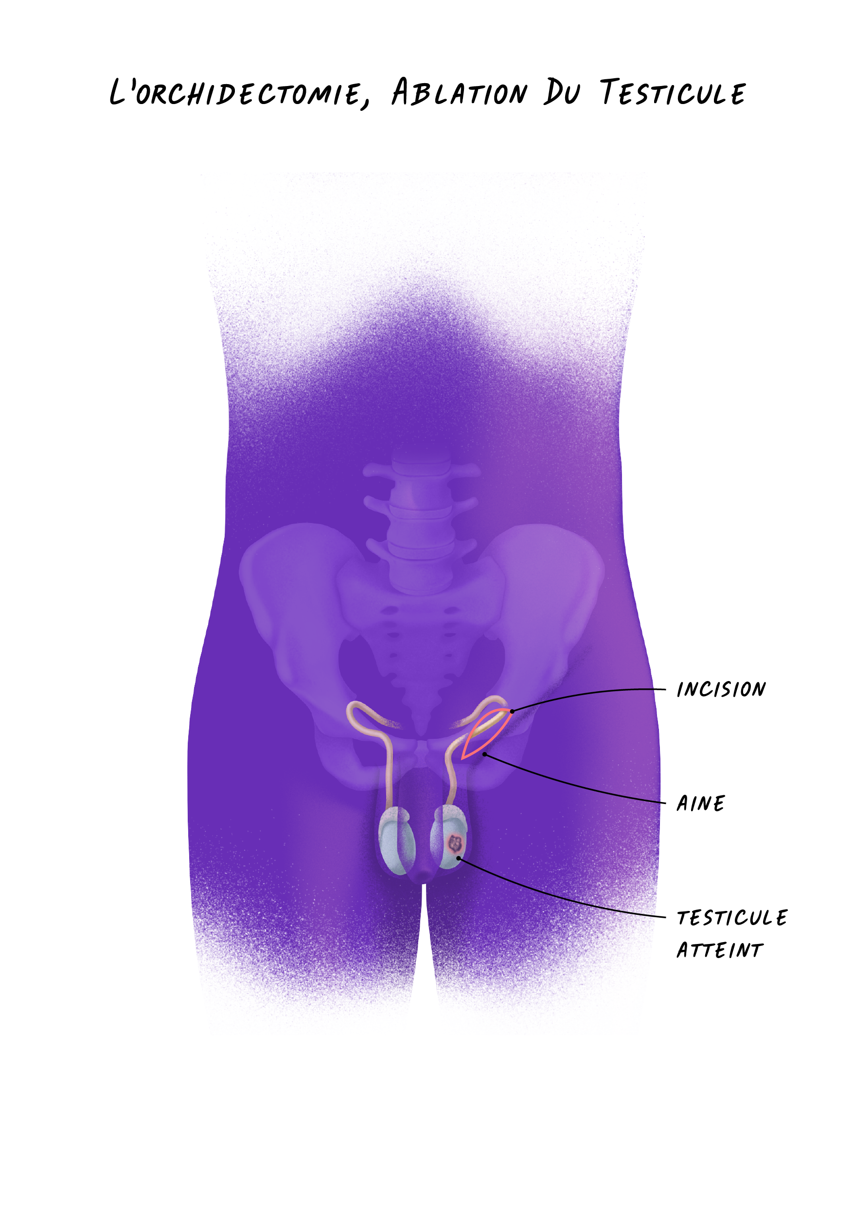 24b Cancers Testicule - L'orchidectomie, Ablation Du Testicule.png